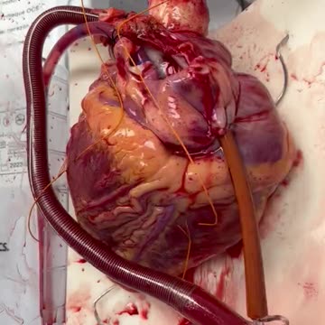 Watch the human heart on its way to a heart transplant