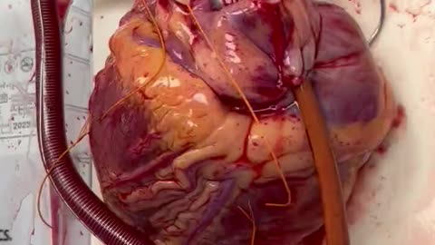 Watch the human heart on its way to a heart transplant