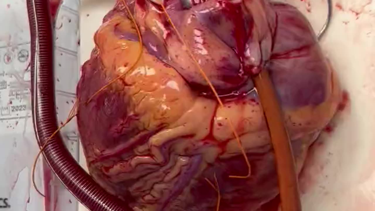 Watch the human heart on its way to a heart transplant