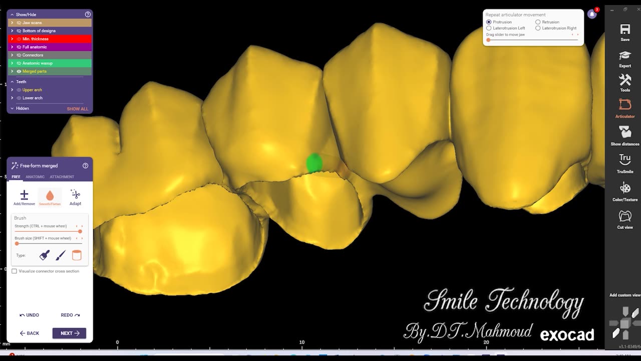 #design #naildesign #dental #dentaldesign #exocadexpert