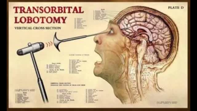 LOBOTOMIA