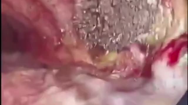 Graphene Oxide Building Spikes In A Jab Victim's Esophagus