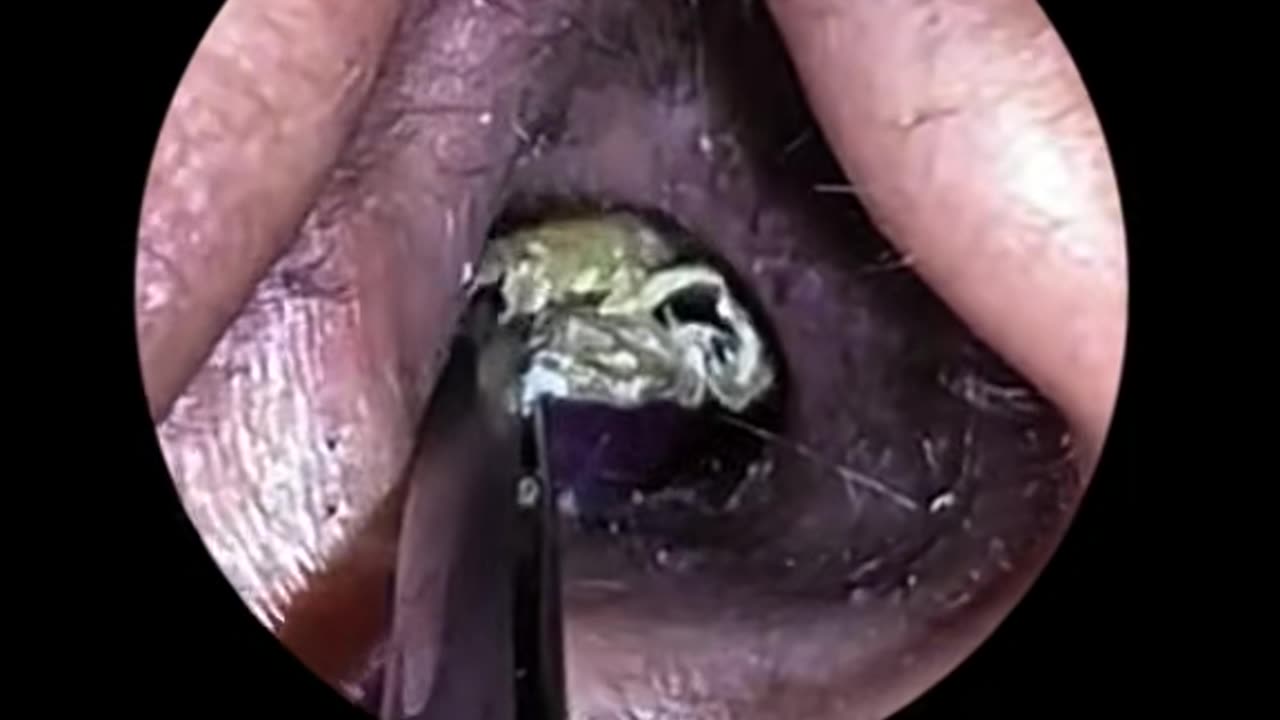 Earwax removal