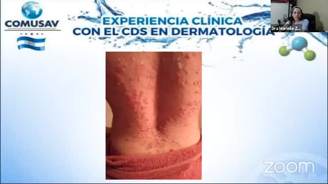 CURADA DE SIORIASIS CON DIOXIDO DE CLORO