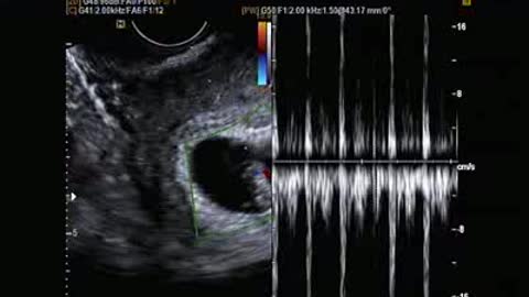 Baby ultrasound