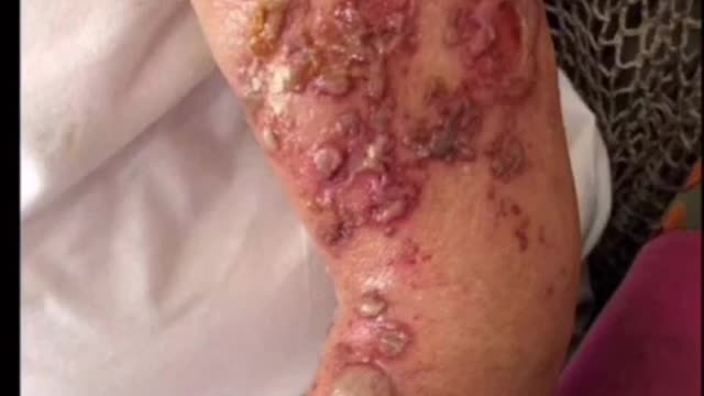 人體_有先天“最好”的免疫保護系統，面對出現大量問題的C_19 vaccine疫苗_實驗針劑，我們是否該先“停、看、聽”呢？疫苗side effect 三