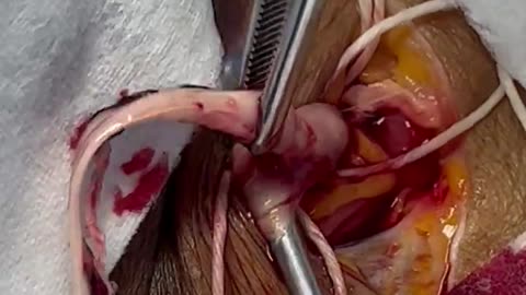 💉 Clot being removed from a jugular vein