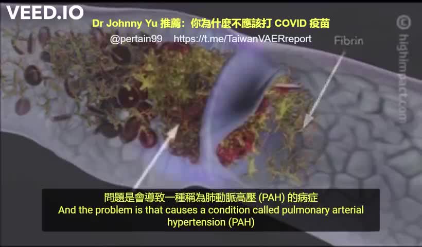 “您為何不應該施打C_19 vaccine疫苗？”疫苗注射入人體的完整過程！Dr.Charles Hoffe解說
