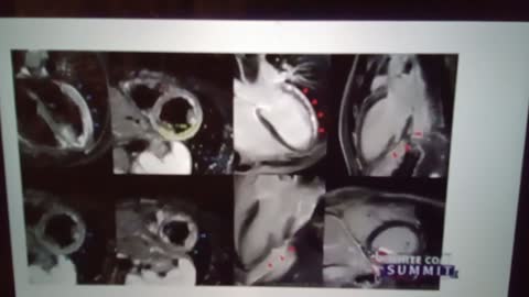 "Clot" Shot - RESEARCH censored real scientific data before 2nd dosing and 'Boosting'!!!!