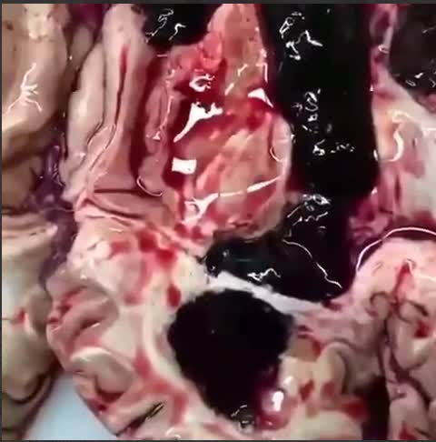 Thromboses of the brain