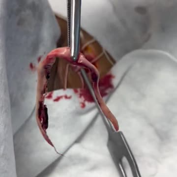 Clots removed from people since 2021