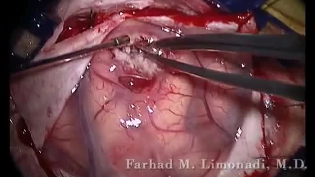 Left Fronto-parietal Craniotomy for resection of glioblastoma multiforme