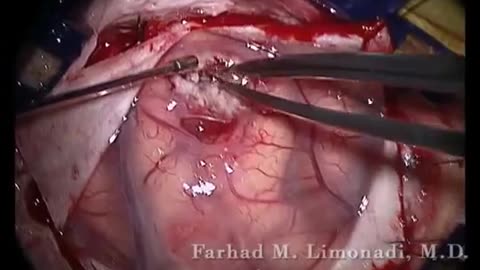 Left Fronto-parietal Craniotomy for resection of glioblastoma multiforme