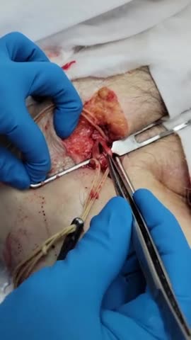 Blodproppar efter vaccin. Varning för otäcka bilder