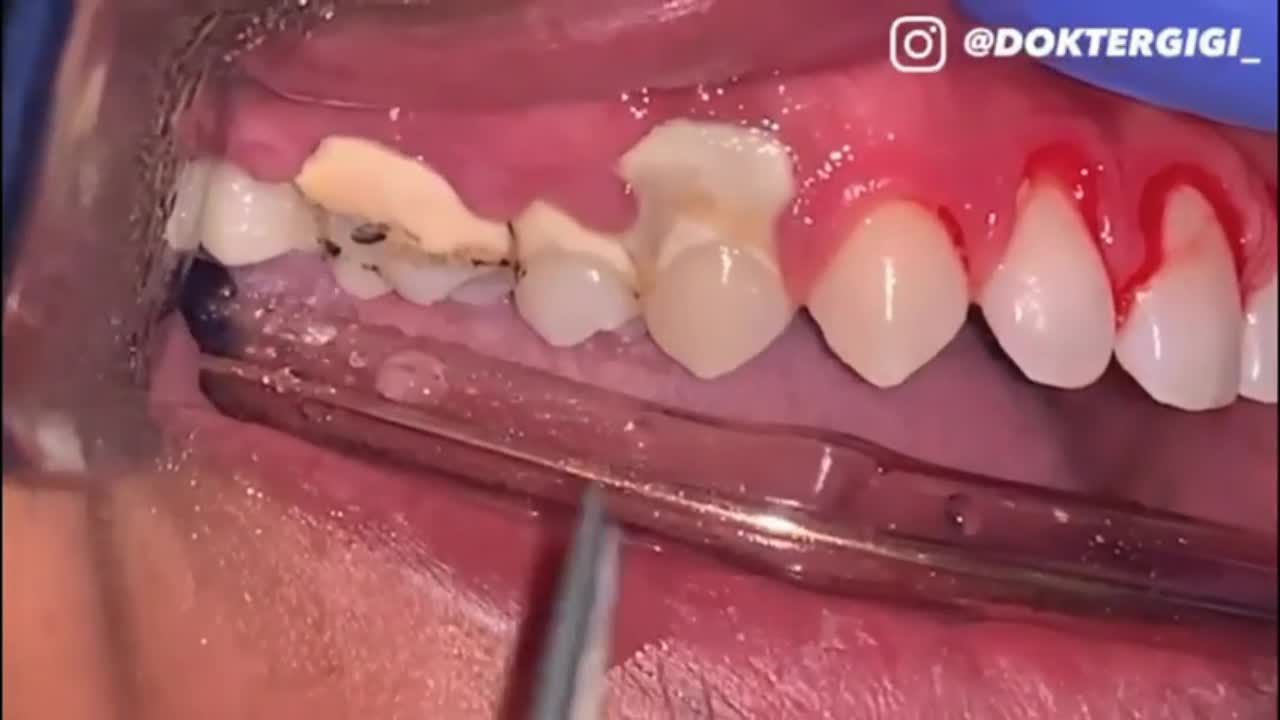 Removal tartar satisfying #1