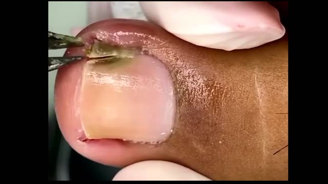 Satisfying Toenail Ingrown Removal