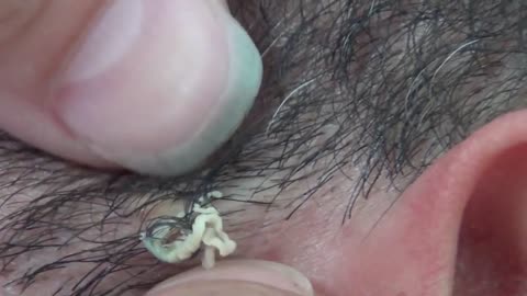 Curly Ingrown Hair Removal Close Up