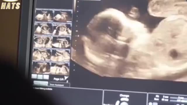Premature Miscarriage from the jab