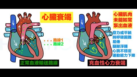 五大症狀 心臟衰竭致死風險高！