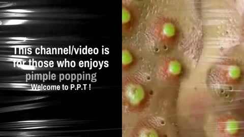 Pimple Popper Tripper Channel Intro