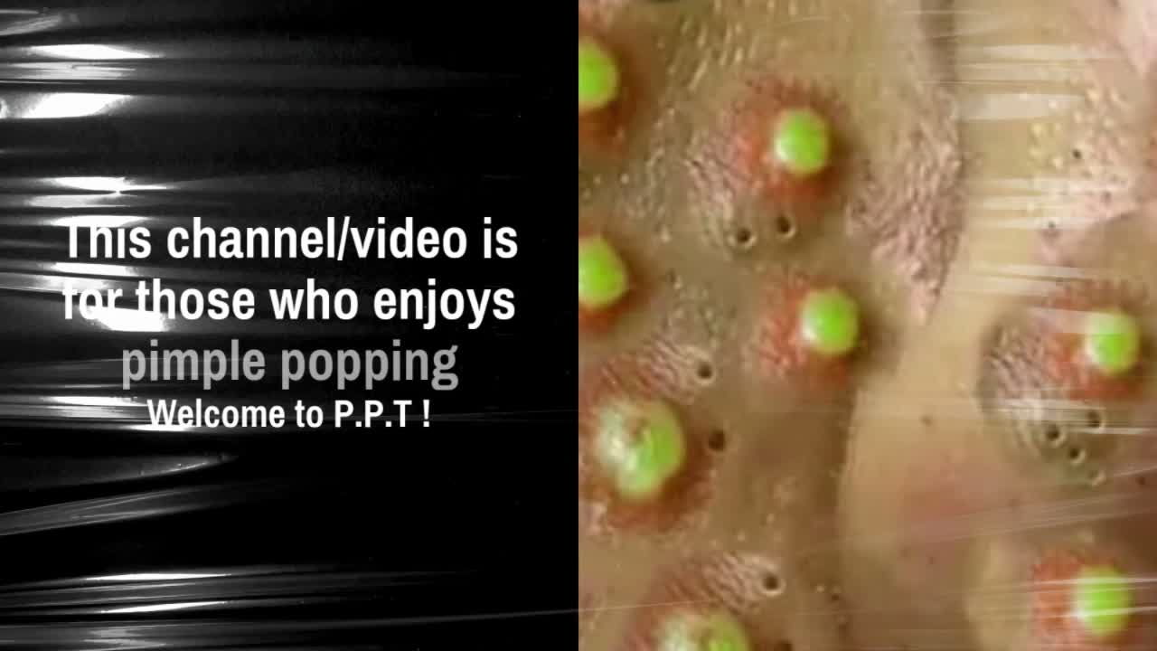 Pimple Popper Tripper Channel Intro