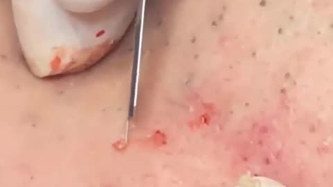 pimple popping