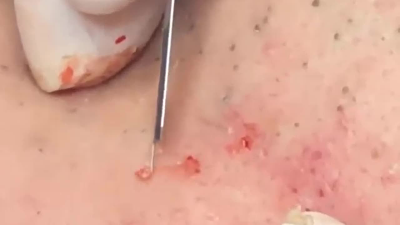 pimple popping