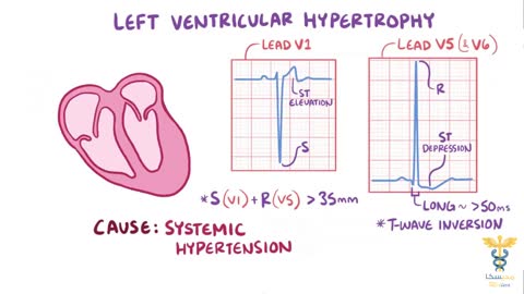 7 ECG cardiac hypertrophy and enlargement