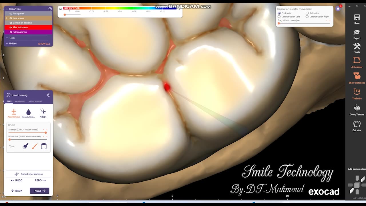 #design #naildesign #dental #dentaldesign #exocadexpert