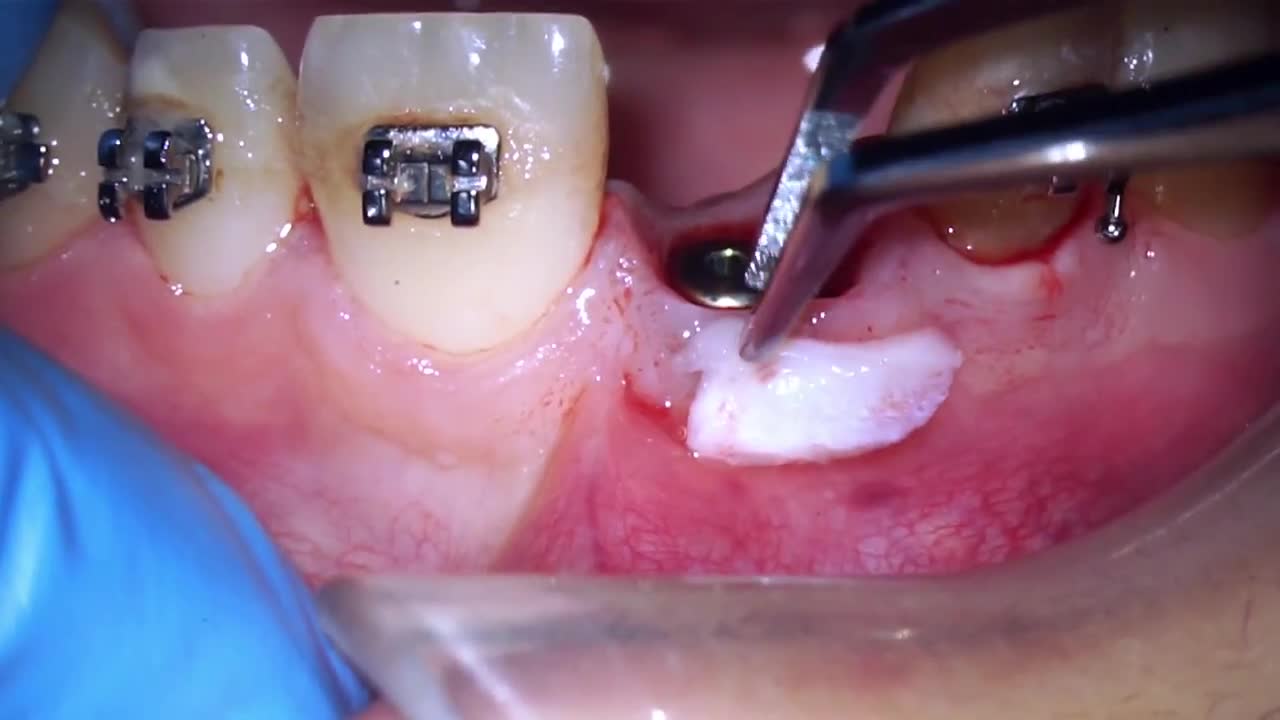 CTG for gingival thickening infant of implant