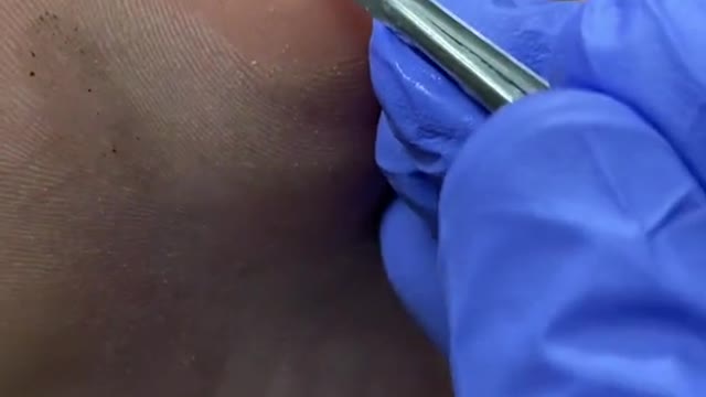Painful Forefoot corn and callus removal by Australian podiatrist