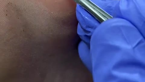 Painful Forefoot corn and callus removal by Australian podiatrist