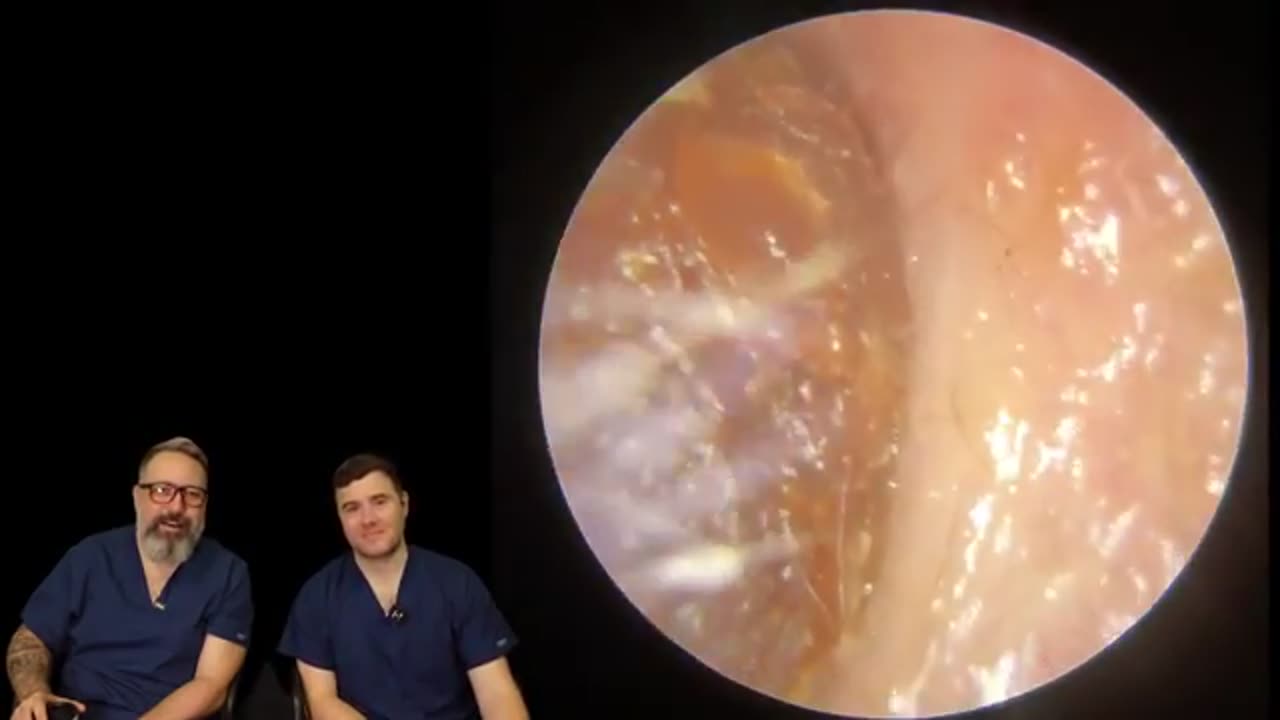 PERFORATED EARDRUM DISCOVERED AFTER EAR WAX REMOVAL - EP2