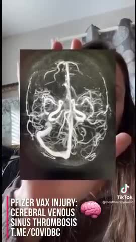 The Pfizer parasite that invades the brain.