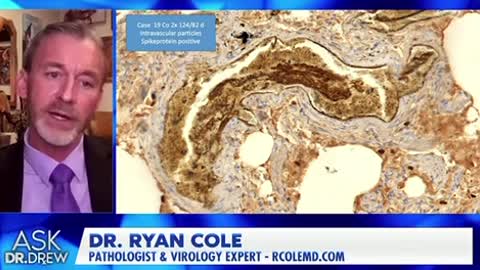Dr Ryan Cole, the spike protein from the clotshots make up large part of all the clots we’re seeing