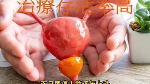 攝護腺癌 治療存活率高