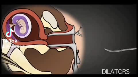 abortion how things work.