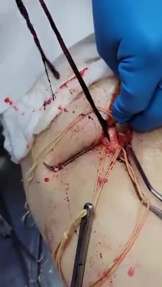 UN MINÚSCULO COAGULITO EN UNA AUTOPSIA.... 🤦‍♂️🤦‍♂️🤦‍♂️🤦‍♂️