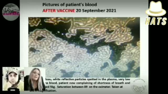 Must watch!💉☠️ Dr. Zandre Botha shows images of Covid-19 vaccine damage in the blood