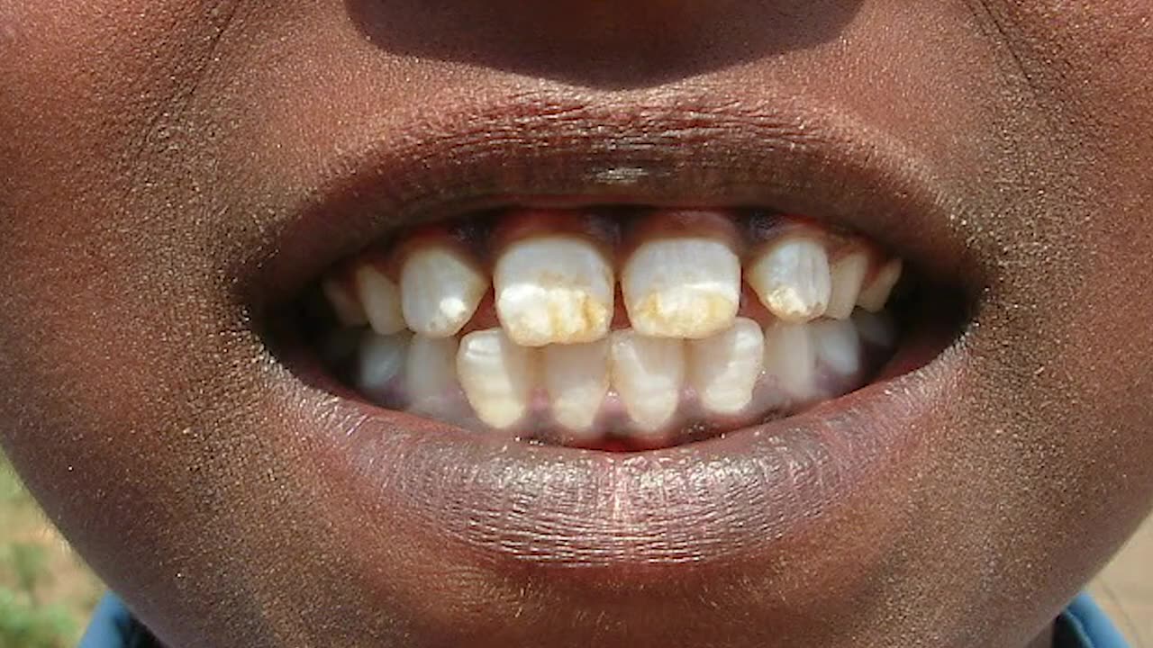 Too Much Fluoride Causes Tooth Decay