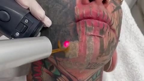 Ouch. #tattoos #tattooremovalspecialists #tattooremoval #ouch