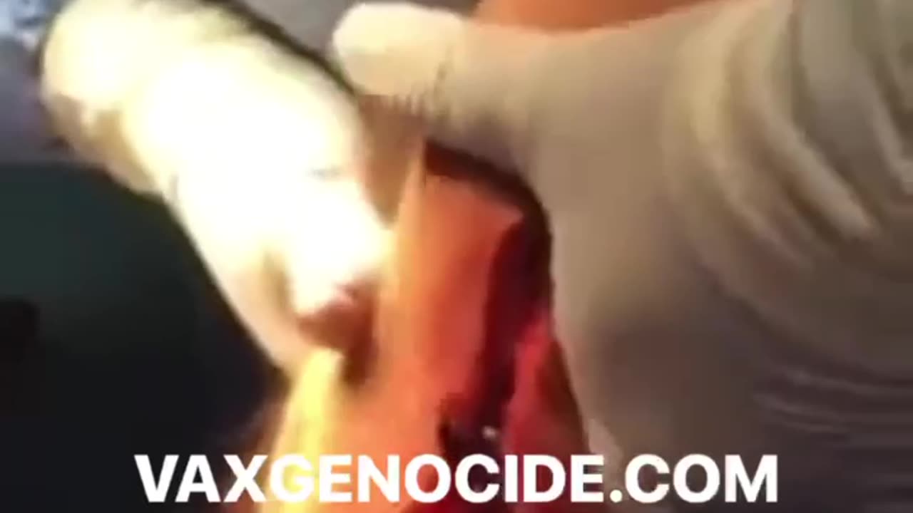 VERY GRAPHIC; BLOOD CLOT REMOVAL FROM FULLY VAXXED PATIENT!