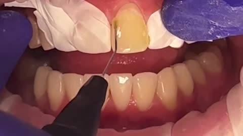 Tooth setup