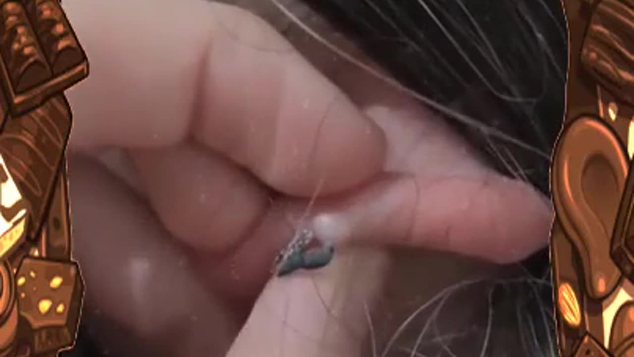 Cleaning comedones Part 9