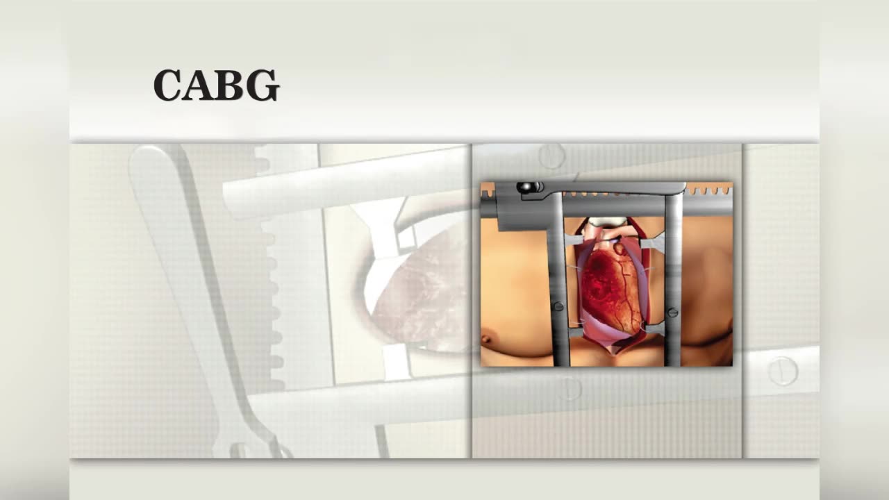 Coronary Artery Bypass Graft (CABG)