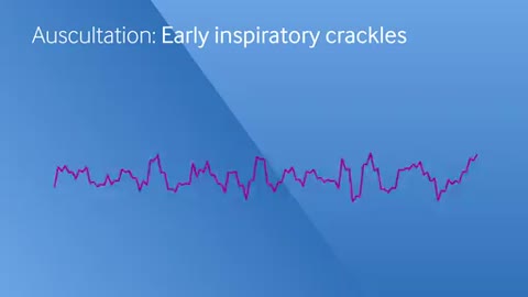Early inspiratory crackles