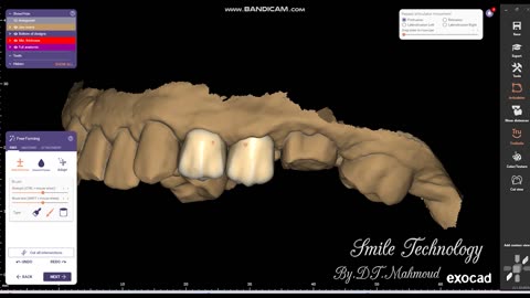 #design #naildesign #dental #dentaldesign #exocadexpert