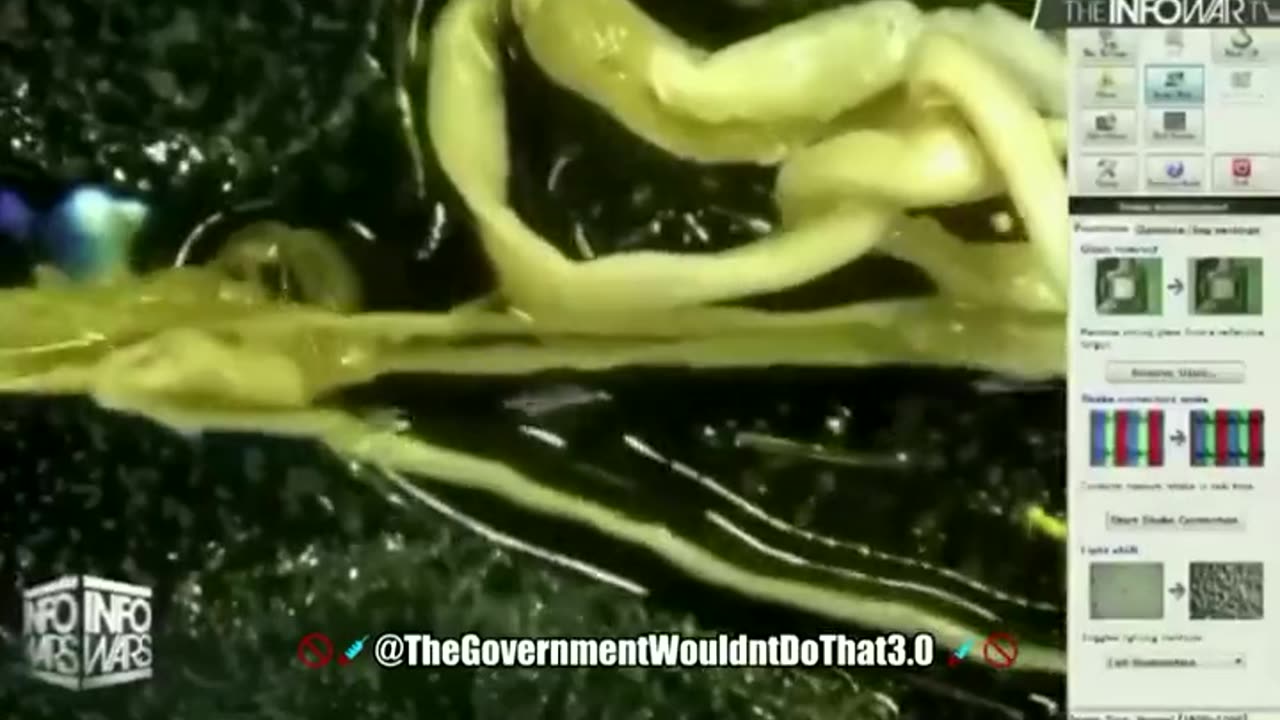 These Odd Never Before Seen Elasticated Clots Are Being Found I Dead "Vaccinated" Bodies