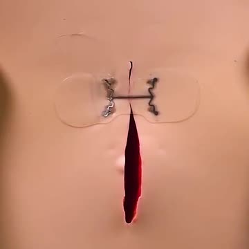 Close that open wound quickly