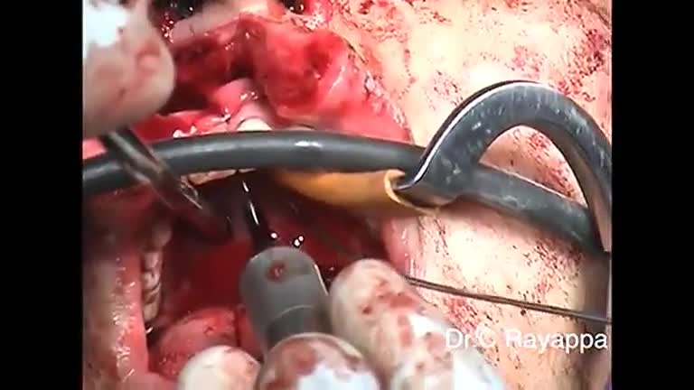 *Surgery* Midfacial Split parotid tumours